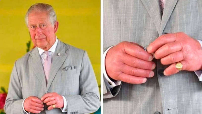 8 Puntos para entender por qué el “Rey Carlos III” tiene los dedos tan hinchados