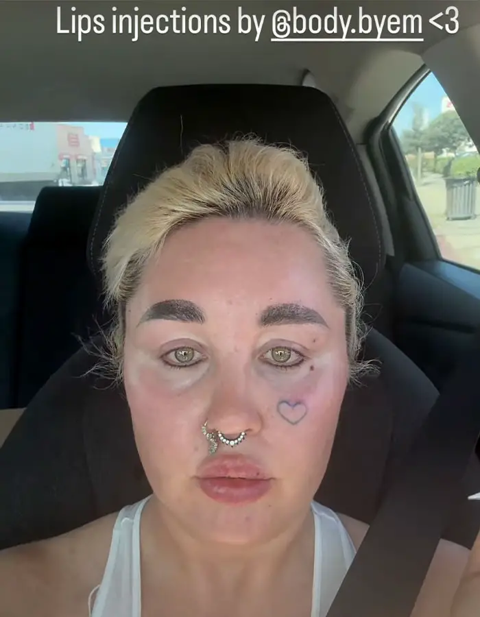 2. "También me inyecté los labios"