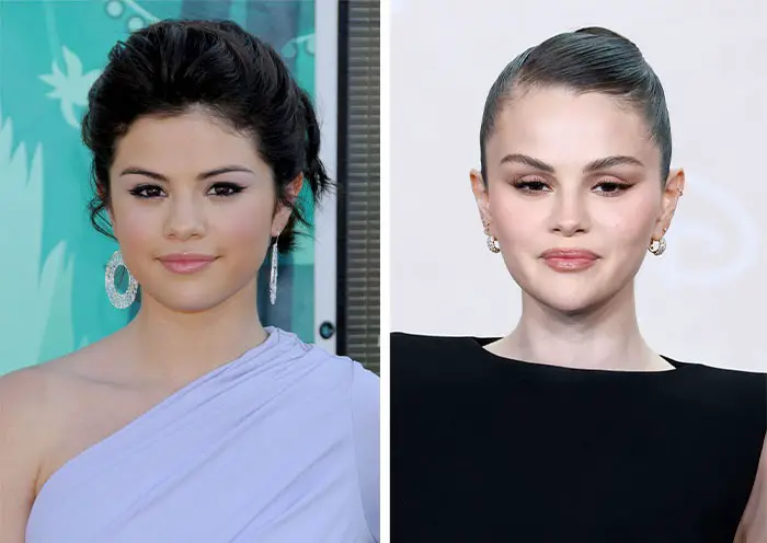 4. Selena admitió el uso de botox y pidió que la dejen en paz